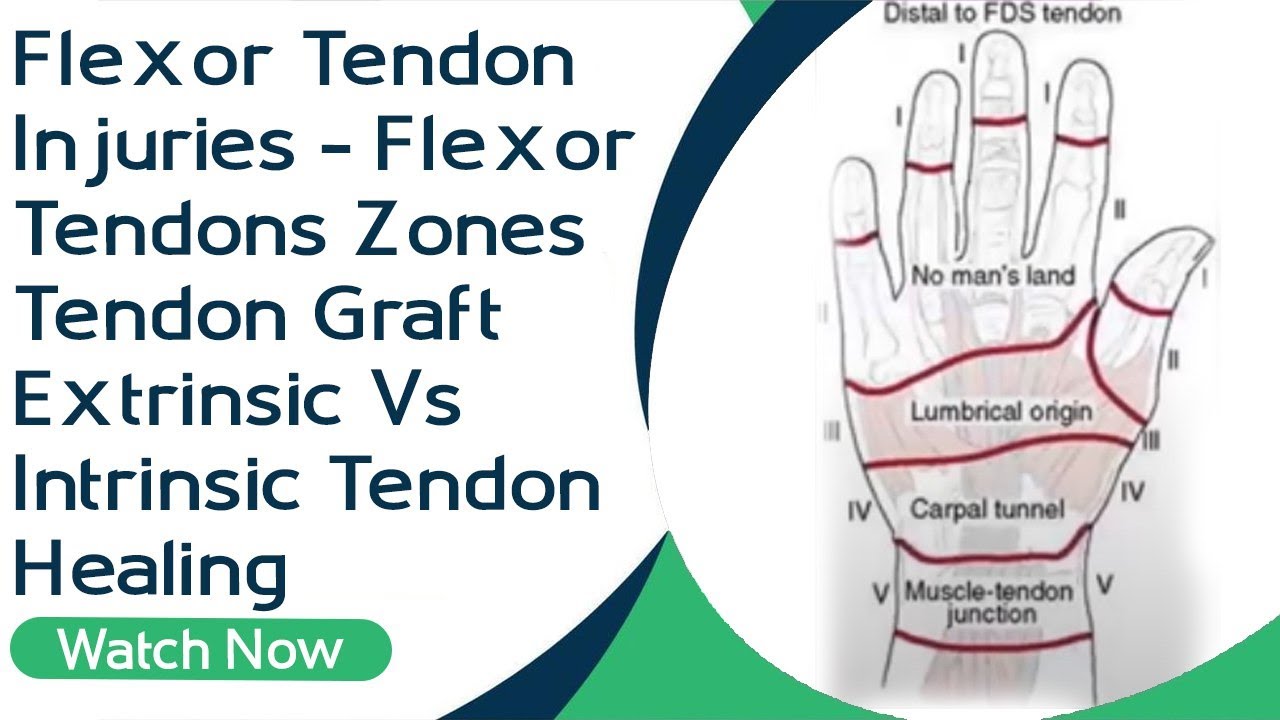 Flexor Tendon Injuries | Flexor Tendons Zones | Tendon Graft | Extrinsic Vs Intrinsic Tendon Healing