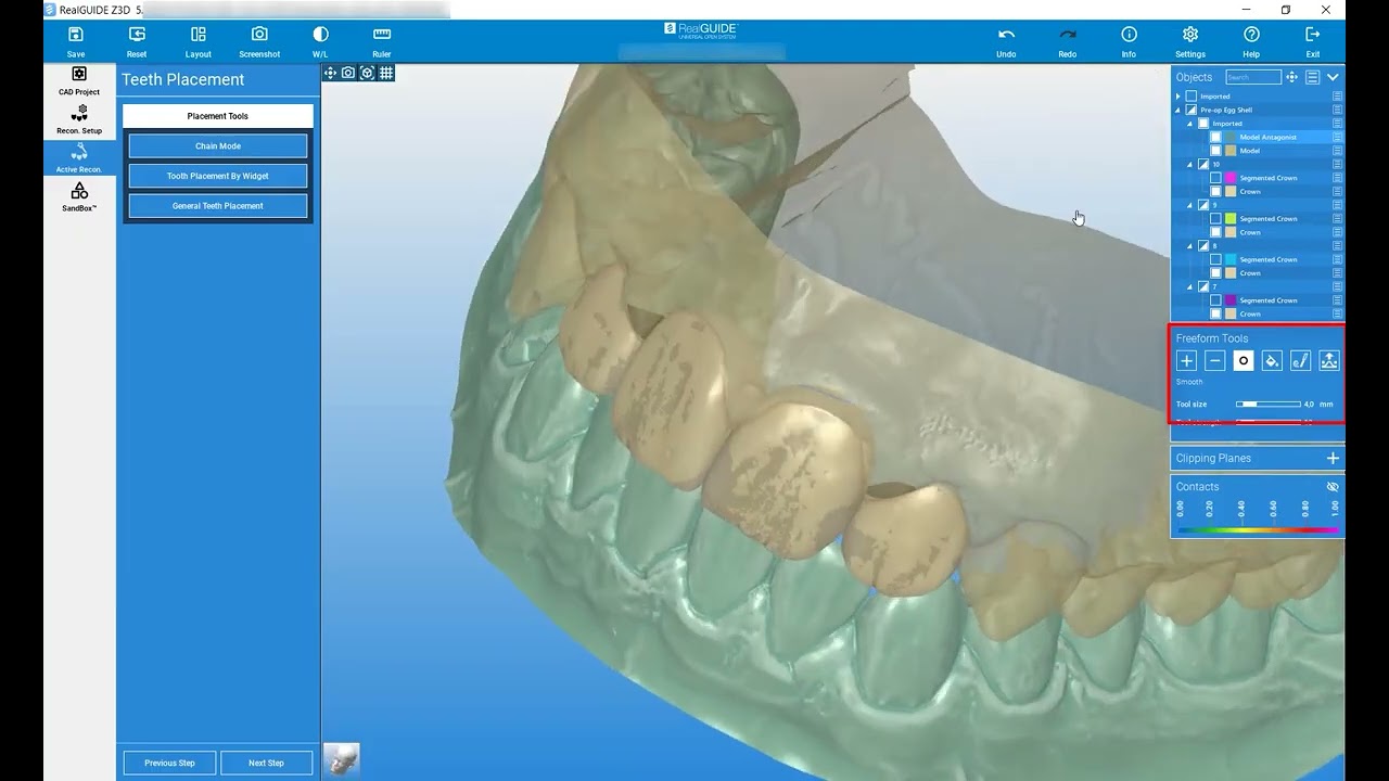 RealGUIDE Software:  Project Setup (Pre-op & Egg Shell Pre-op)