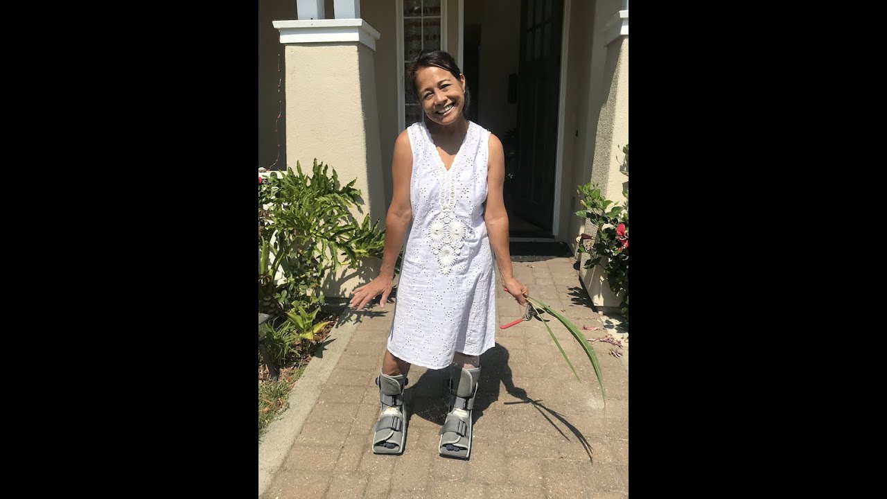 20 days Post bilateral BUNIONSurgery