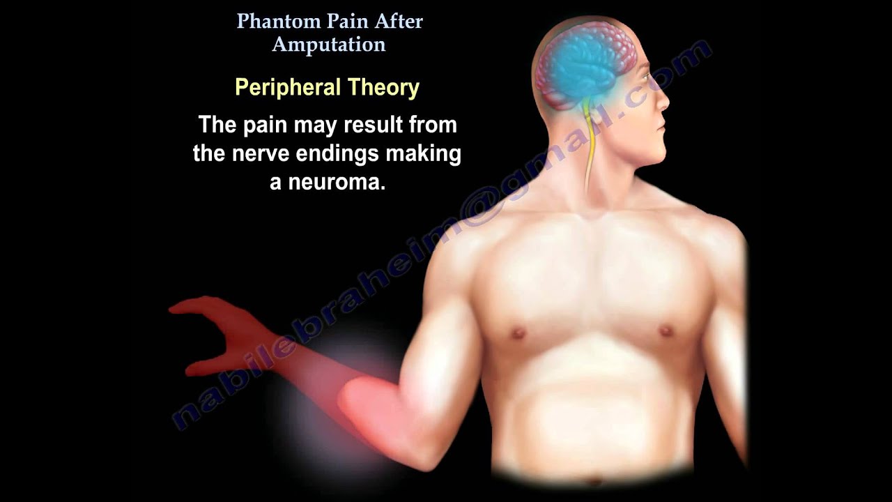 Phantom Pain Amputation - Everything You Need To Know - Dr. Nabil Ebraheim
