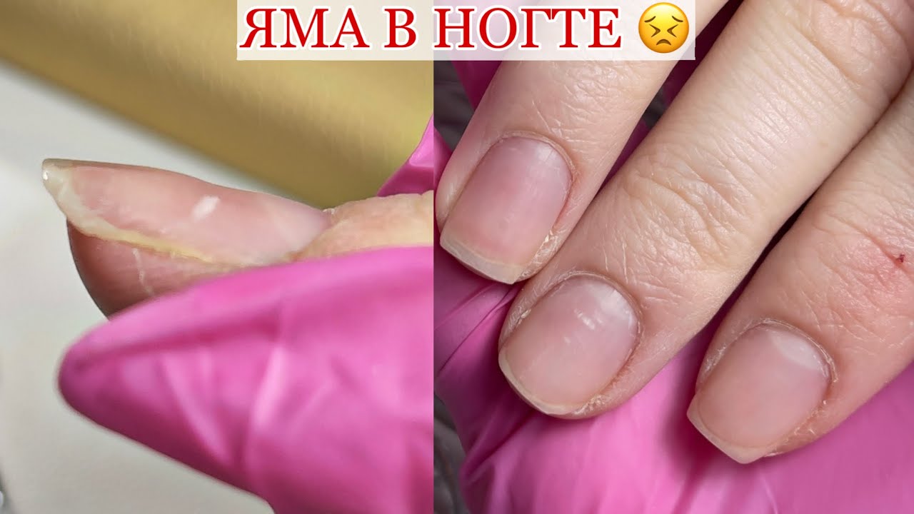 Начудила/ЯМА В НОГТЕ🥺Укрепление твердым гелем