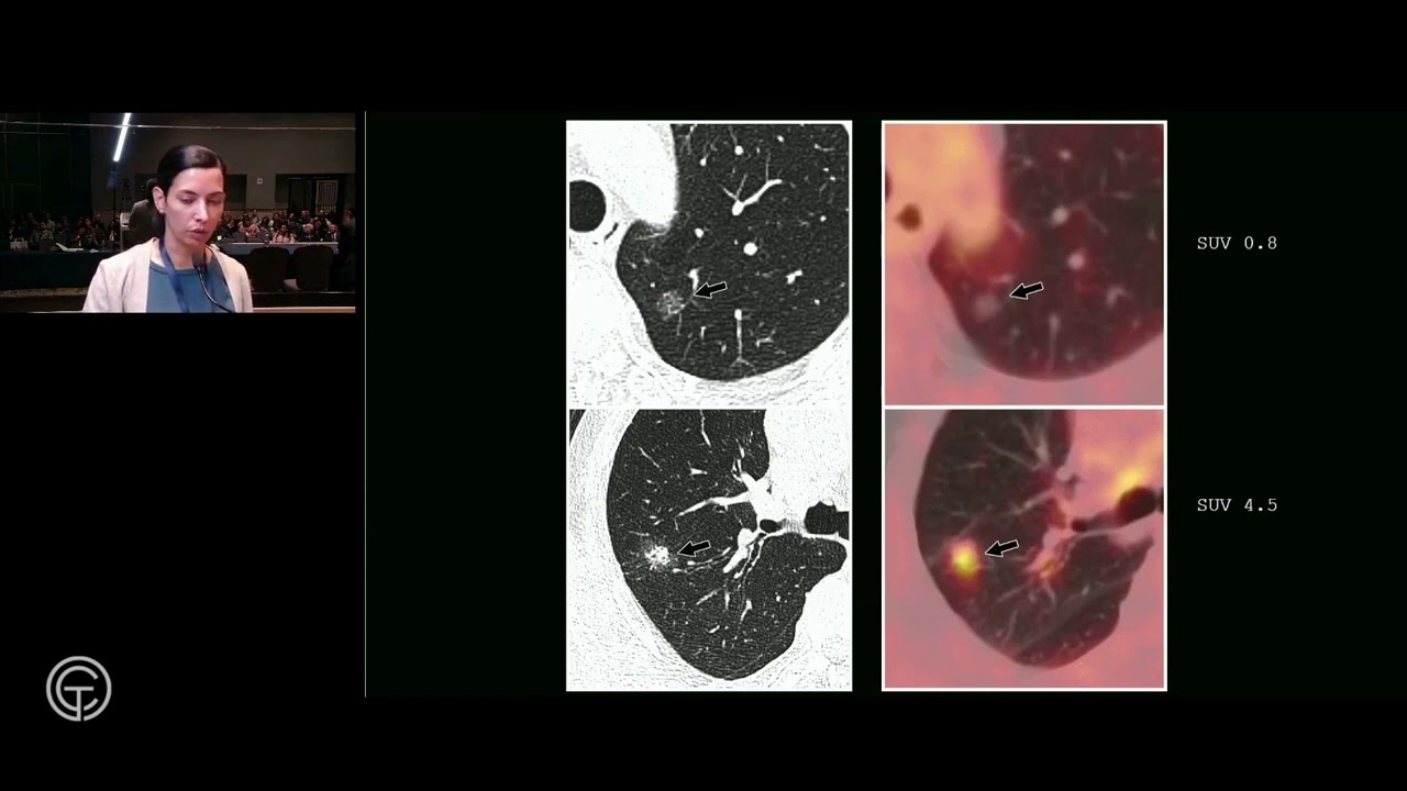 PET/CT en cáncer de pulmón. Dra. Rocío Pérez Johnston.