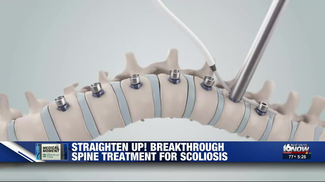 Medical Moment: Breakthrough spine treatment for scoliosis