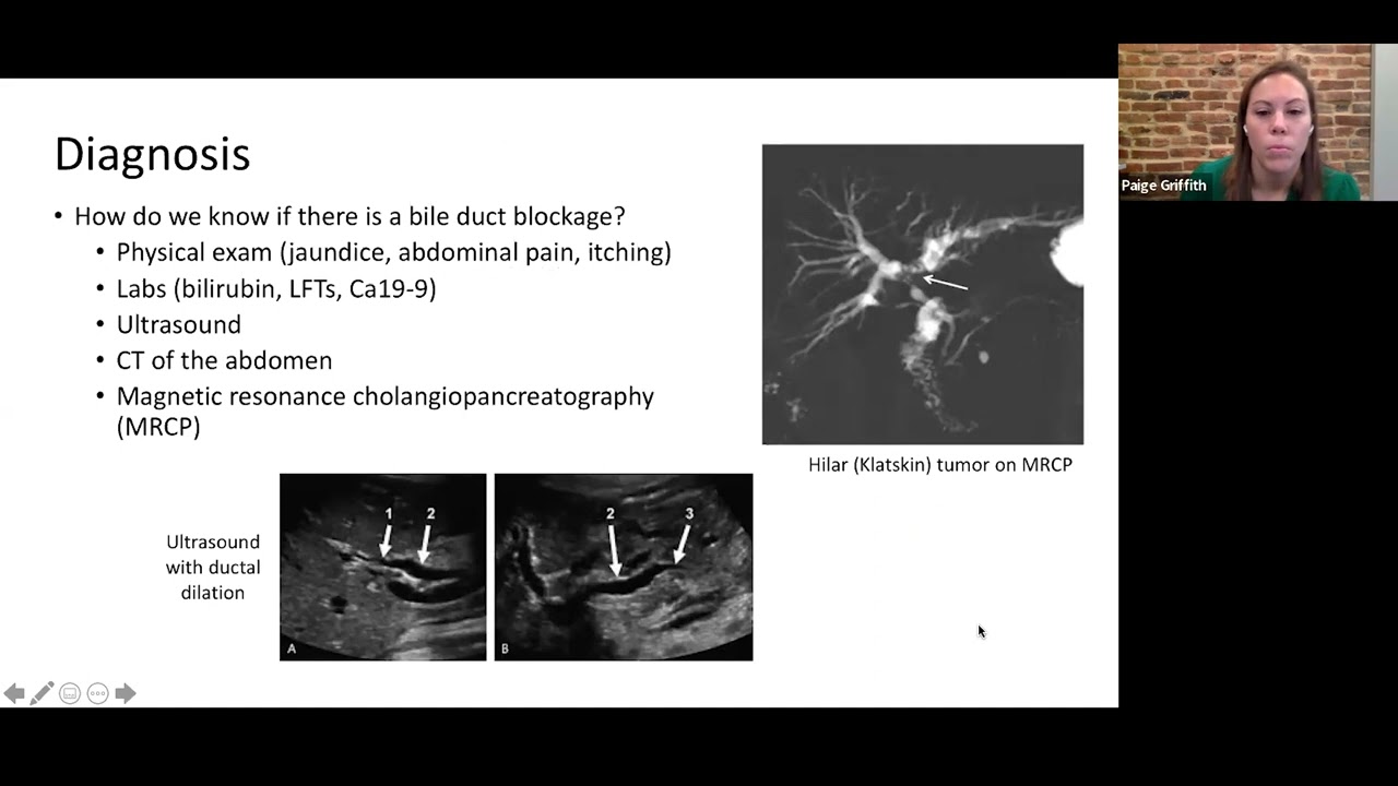 Webinar: Biliary stent and drain management for patients with cholangiocarcinoma