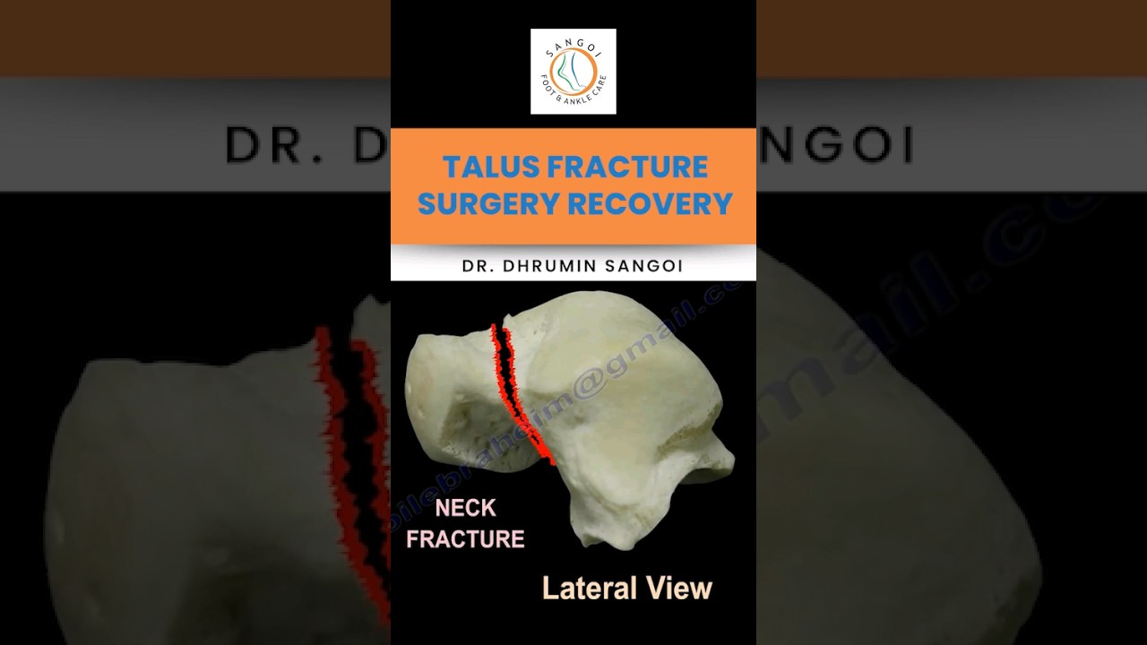 Talus Fracture Surgery Recovery +91-8960356035     www.sangoifootankle.com   #footandankle