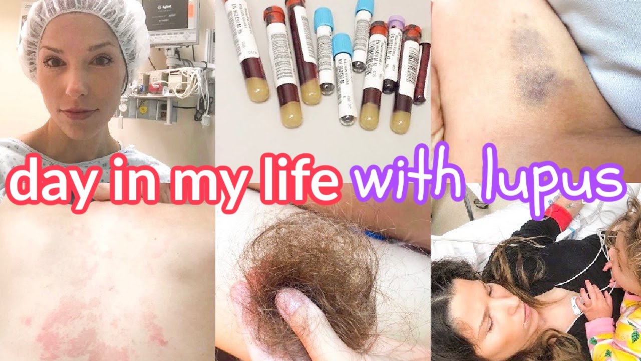 DAY IN MY LIFE WITH A LUPUS FLARE