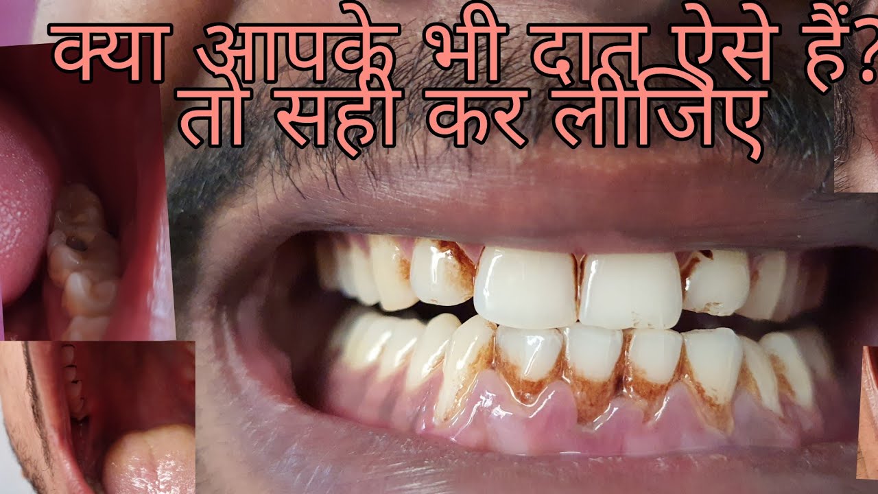 🇮🇳Indian Army medical Test part-3 Hindustanphysicalacademy#medical_test #Hindustan_physical_academy