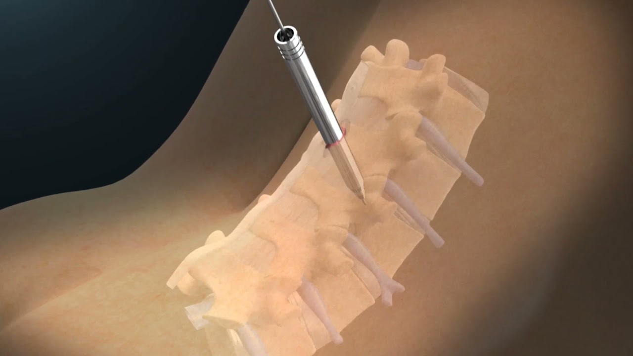 Wiltrom Percutaneous Screw Procedure