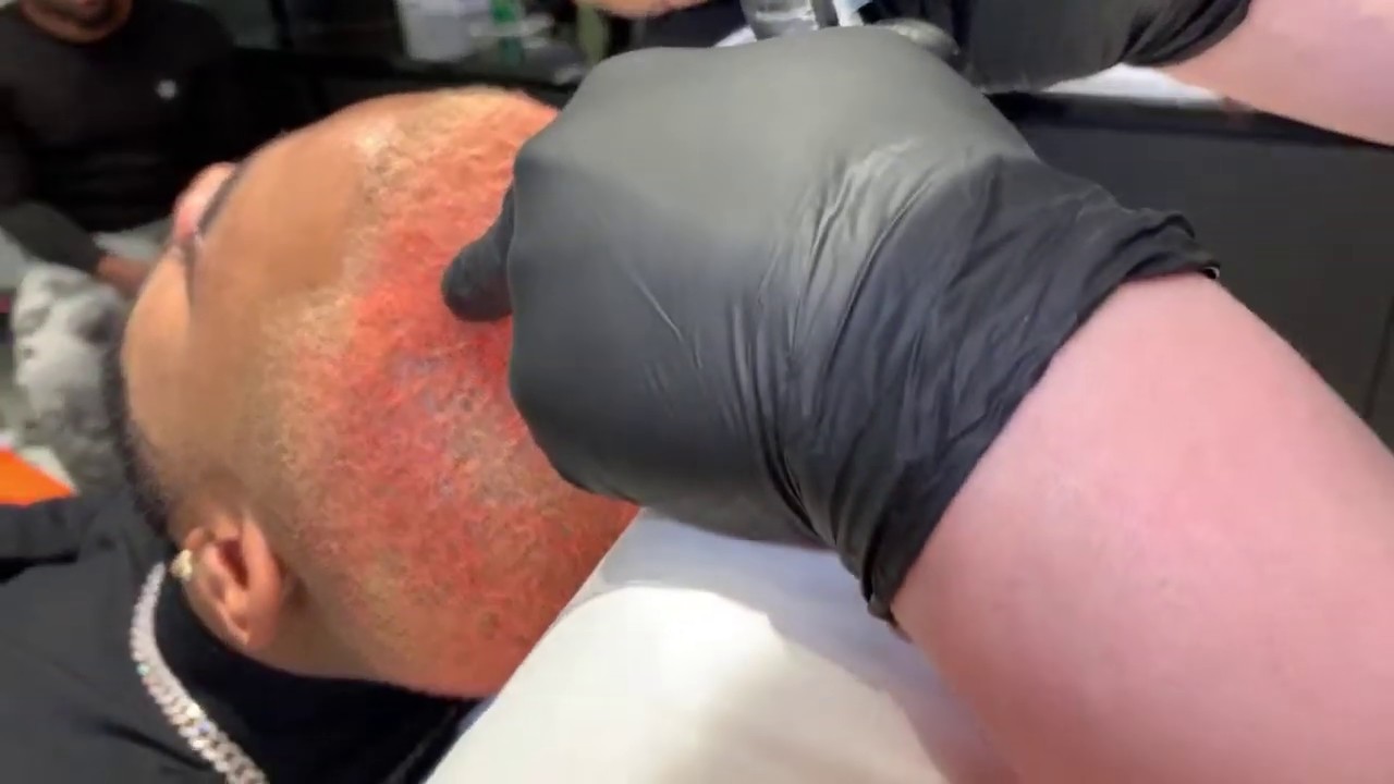 PRP Injections for Thin Hair | Hair Strengthening Treatment | West Hollywood, CA | Dr. Jason Emer