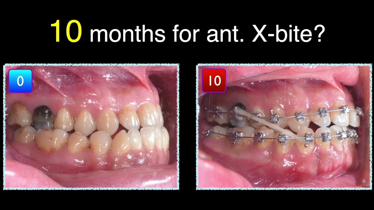 CIII correction with self-ligation system |【Chris Chang Ortho】CC858