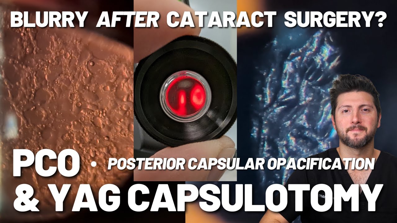Explained: PCO & YAG Laser Capsulotomy 