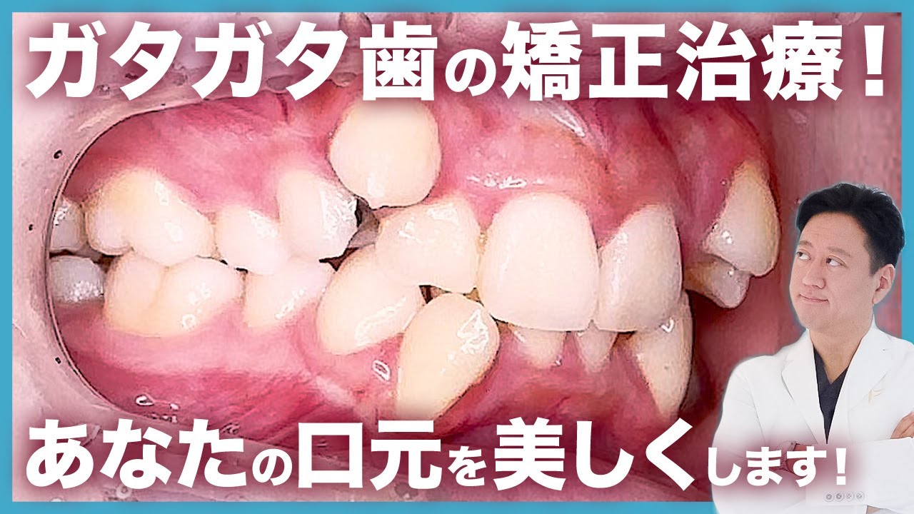 ガチャ歯の歯列矯正はお任せください！芸能人やインフルエンサーの口元を美しくしてきた歯科医師がこっそり教えます【審美歯科 歯並び ガチャ歯 抜歯】