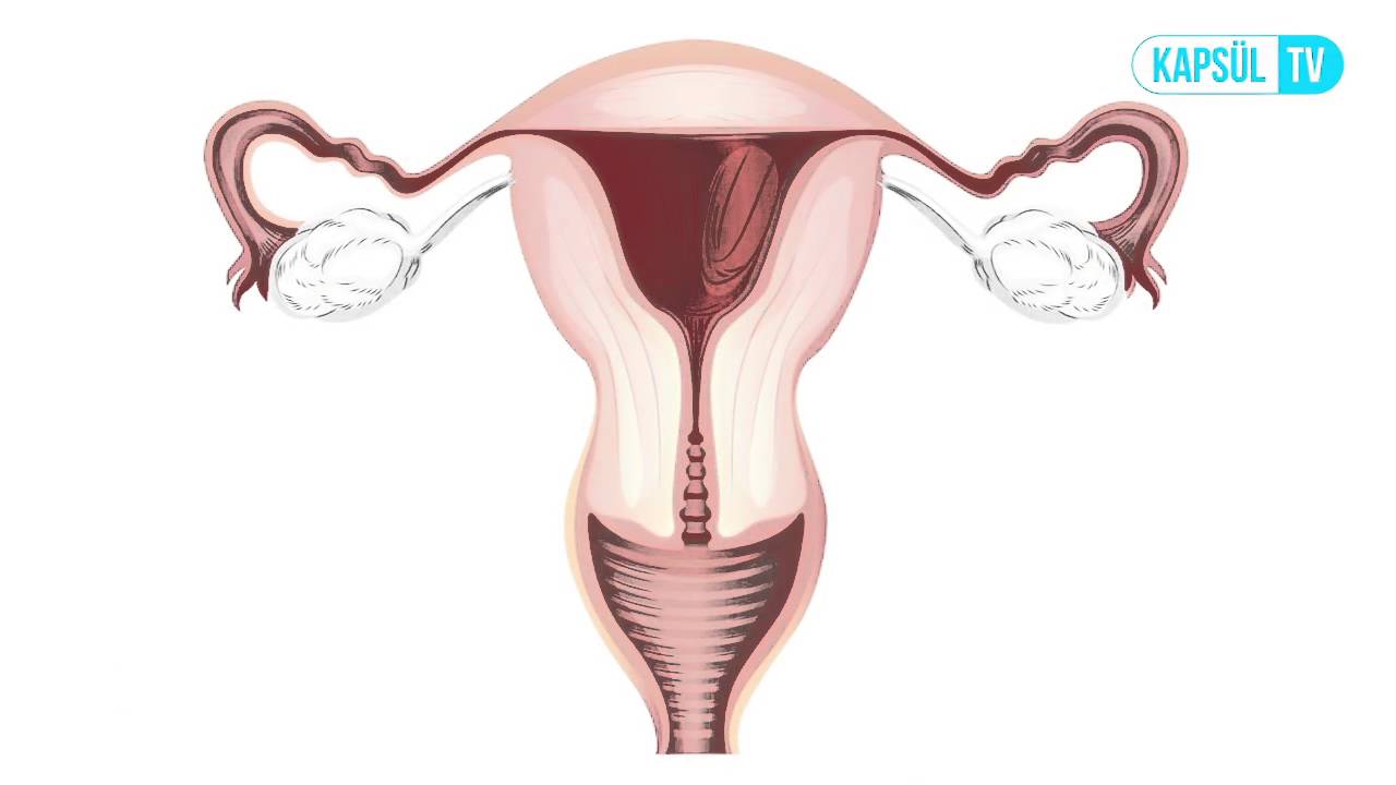 Adenomyozis Nedir?
