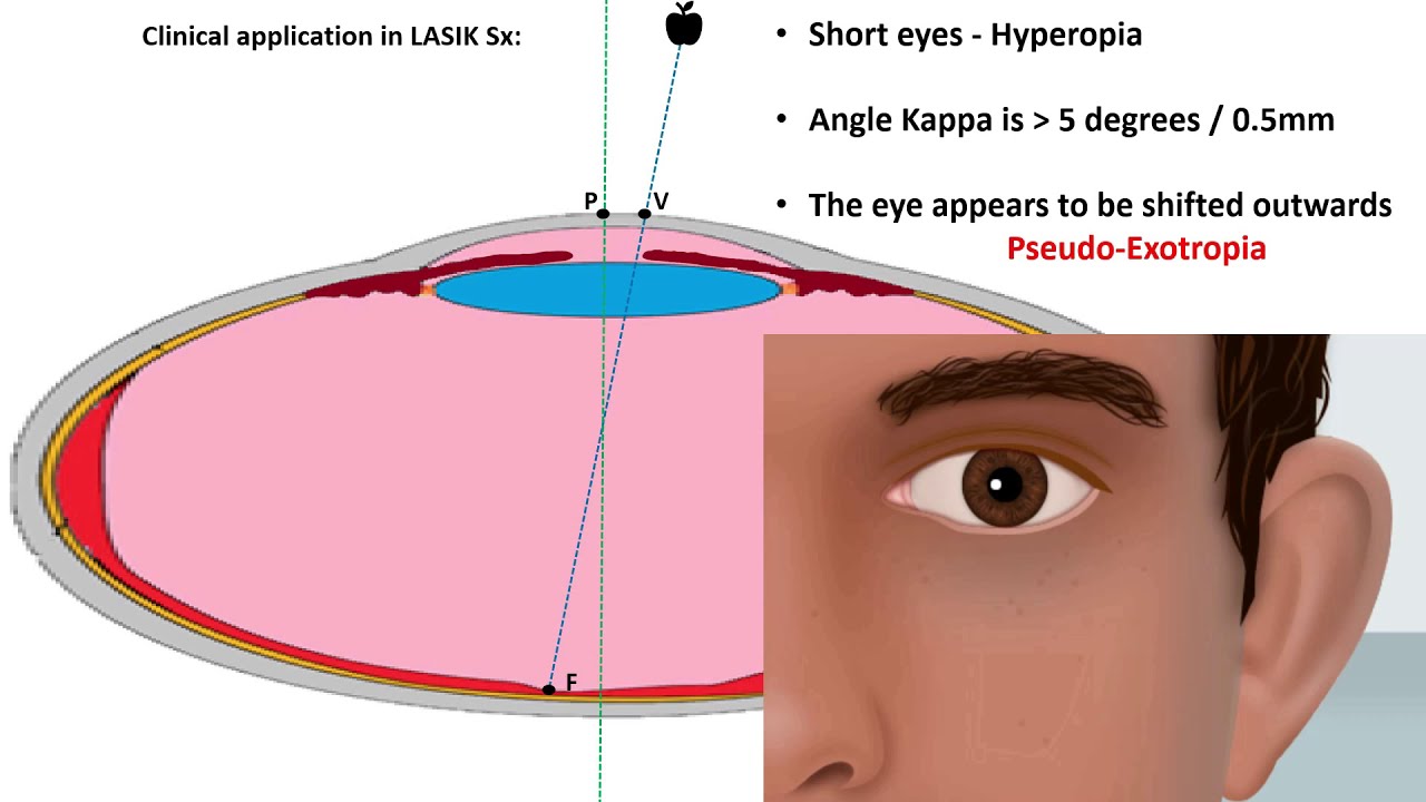 SQUINT VIDEO LECTURE SERIES PART 1 Dr Zain Khatib