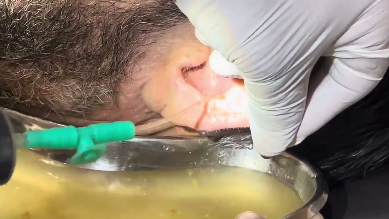Bilateral Impacted Cerumen Extraction and Hearing Restoration in an Elderly Patient.
