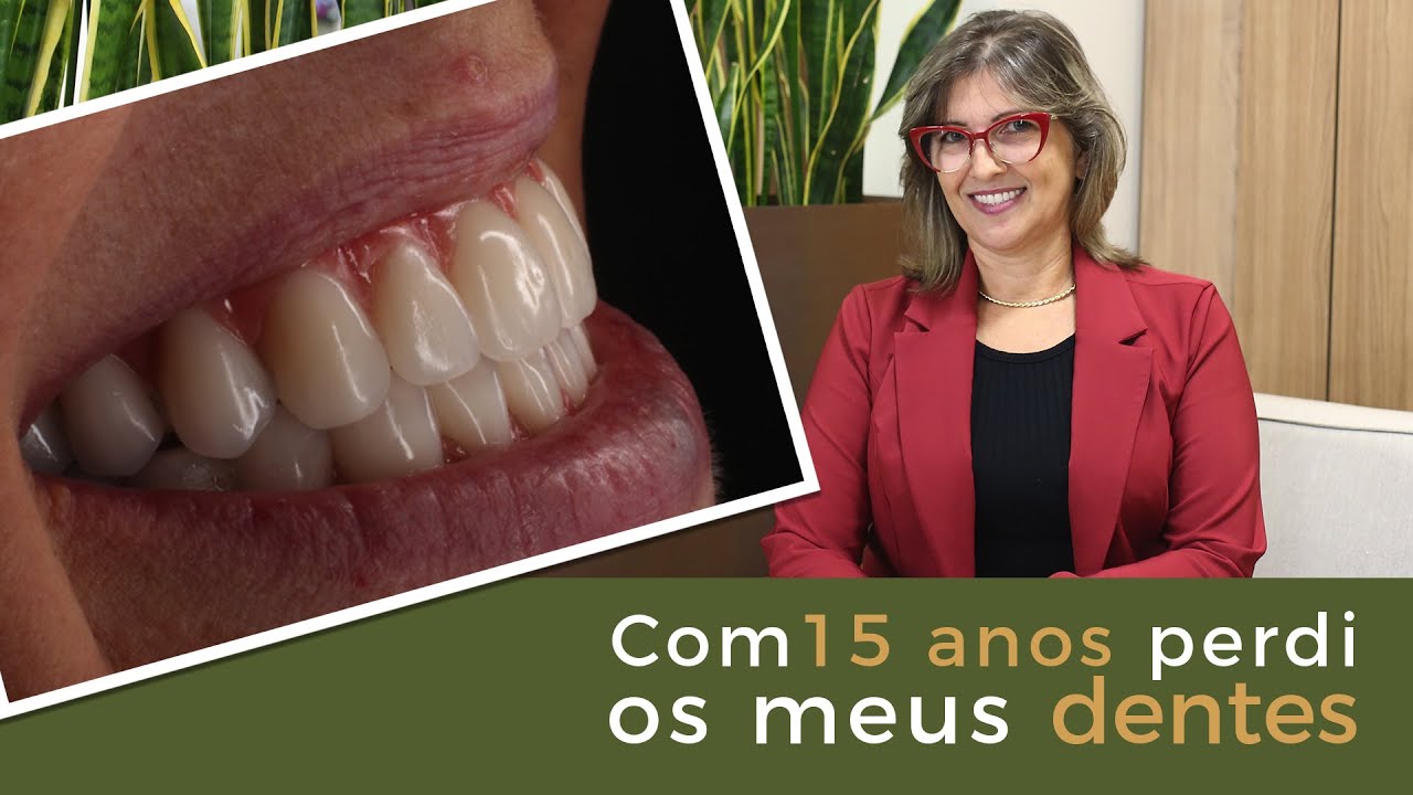 Aos 15 Anos Perdi Meus Dentes e Só Agora Com os Implantes Pude Sorrir Novamente - Implace Implantes