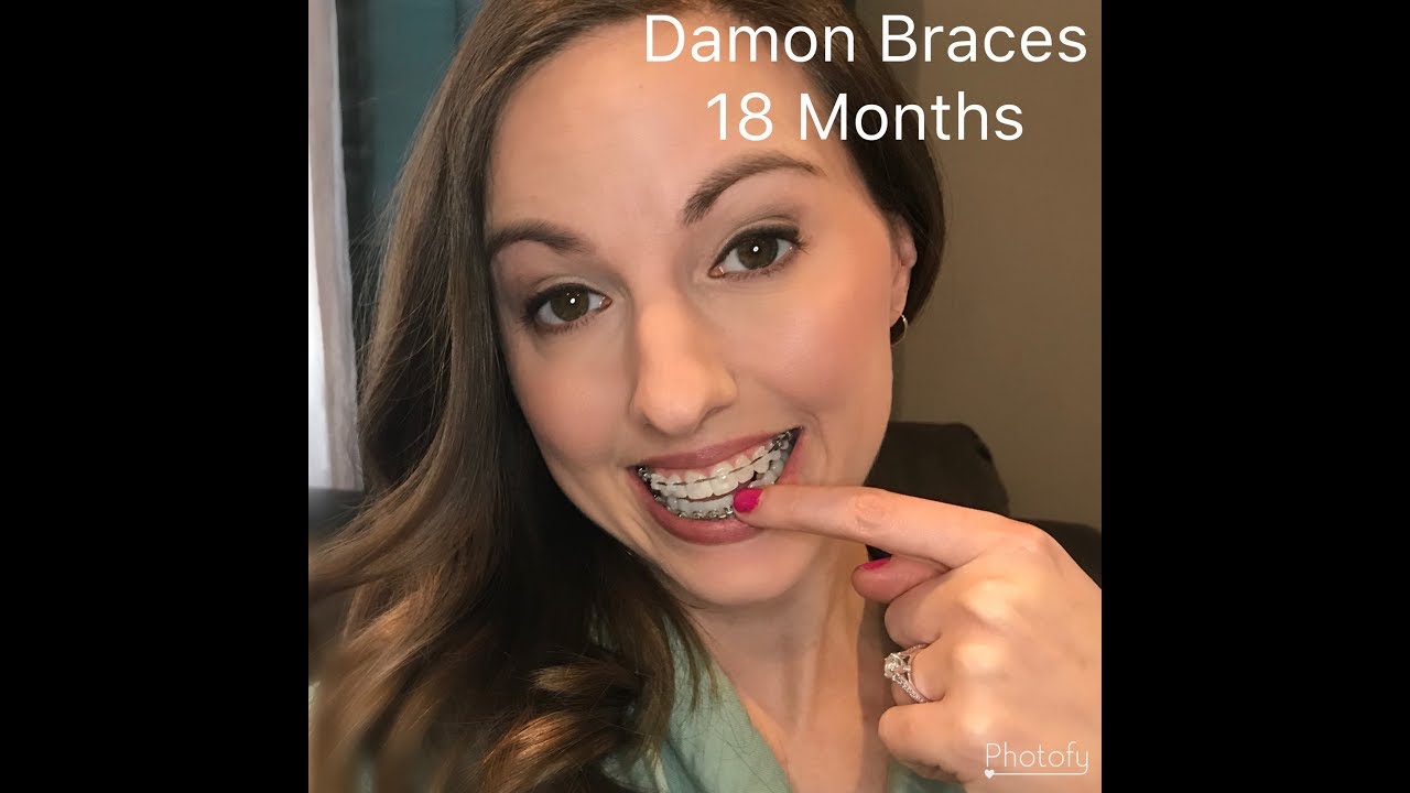 Damon Braces Vlog 9