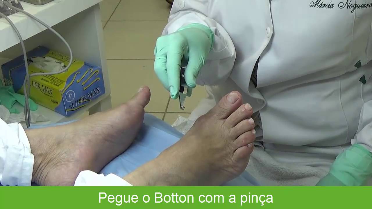 Colocação dos bottons (Podologia)