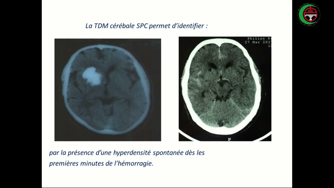 Pr S AMALOU : Diagnostic des accidents vasculaires cérébraux