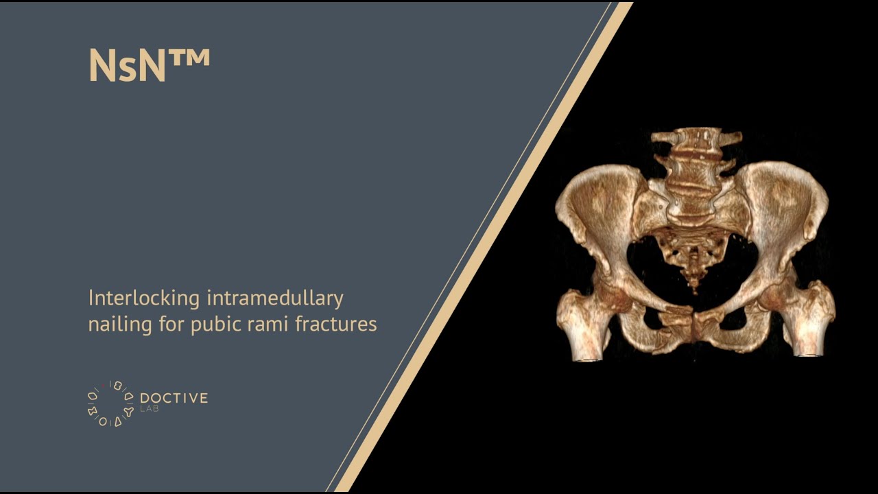 Interlocking intramedullary nailing for pubic rami fractures. NsN&trade;