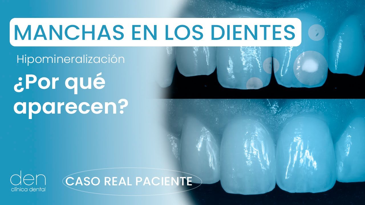 ¿Por qué aparecen manchas blancas en los dientes?🤔 #manchasenlosdientes  #Hipomineralizacion