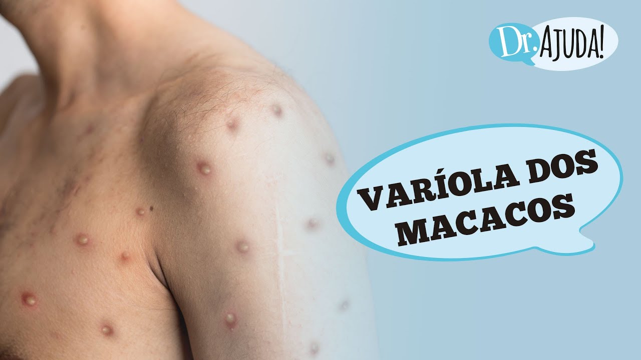 VARÍOLA DOS MACACOS: O QUE É? SINTOMAS? TRANSMISSÃO E PREVENÇÃO