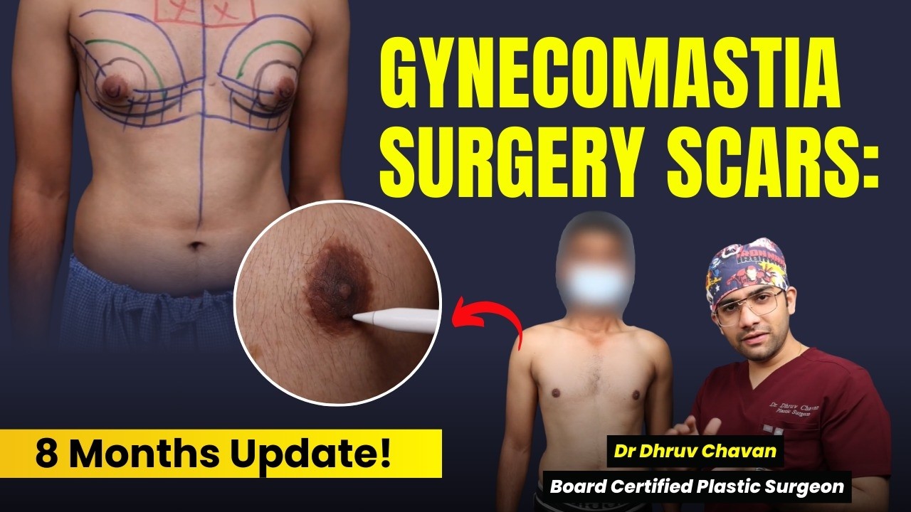 8 Months After Gynecomastia Surgery! | देखिये Gyno Surgery के बाद Recovery! | Dr DC, Pune