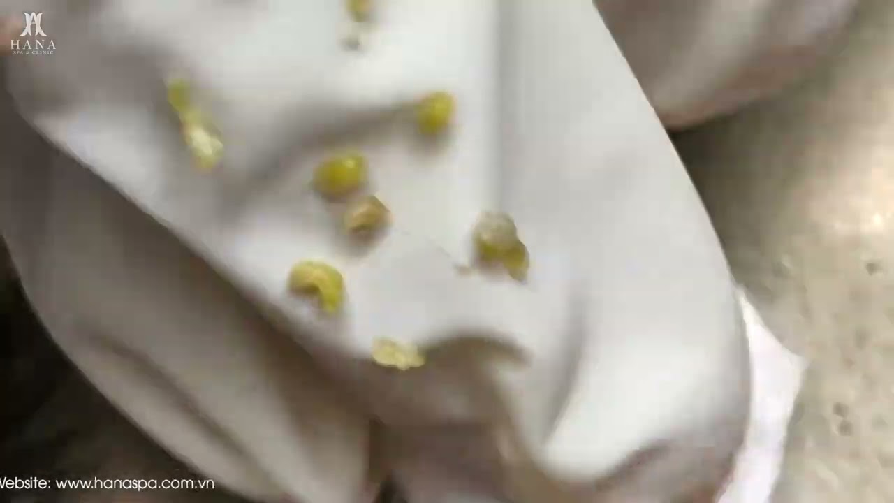 Big Cystic Acne Blackheads Extraction Blackheads & Milia, Whiteheads Removal Pimple Popping
