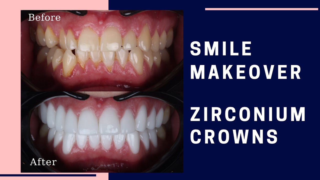 Cosmetic Dentistry in Turkey | Highly Recommended Dental Clinic in Turkey