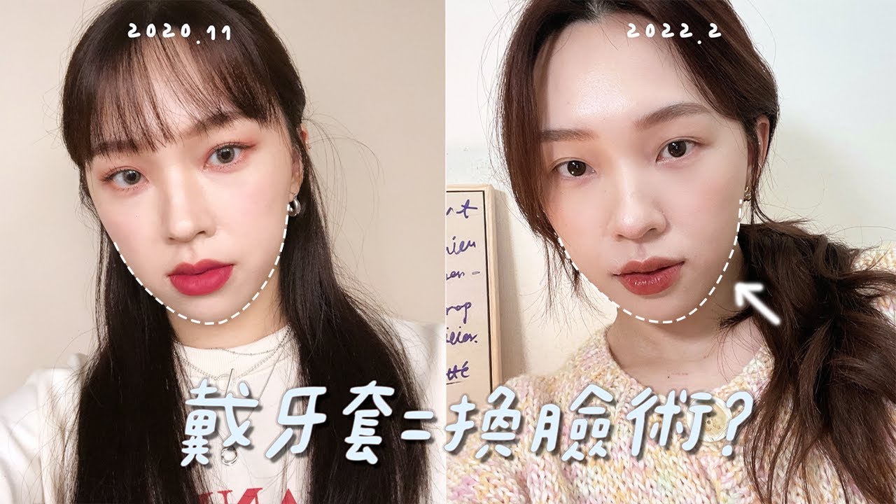 臉整個小一圈🤯隱適美牙套第二集 | 模擬動畫 | 牙套臉？ | 不用打骨釘的理由 | heyitsmindy