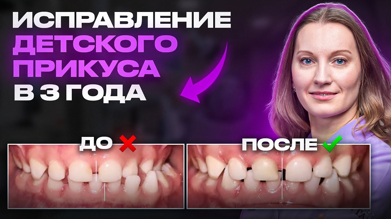 КАК РАСПОЗНАТЬ РАНЕЕ НАРУШЕНИЕ ПРИКУСА У ДЕТЕЙ?