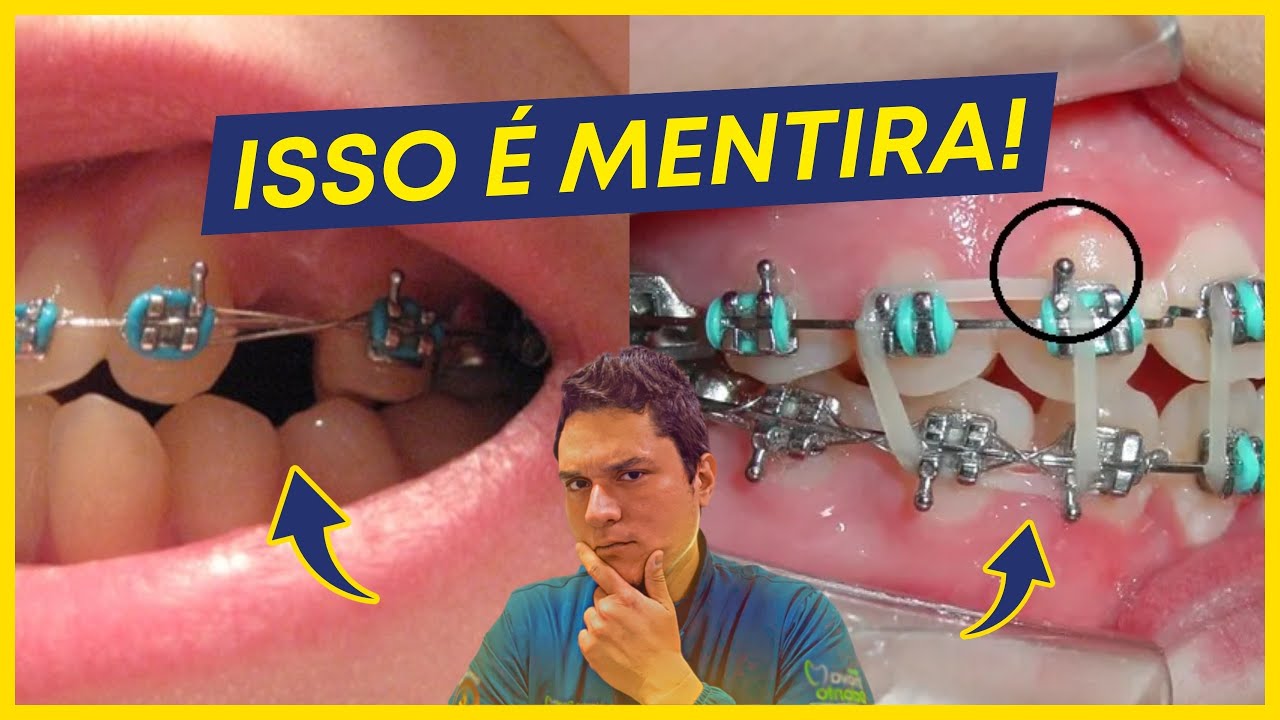 7 MENTIRAS sobre ORTODONTIA que MUITOS acreditam...