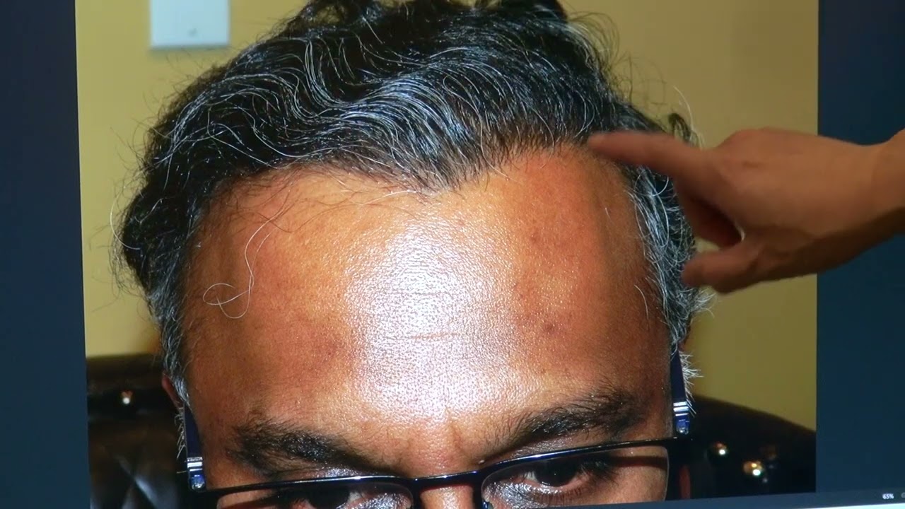 Restoring 20 Years of Youth | 1-Year Hair Transplant with Natural Zigzag Hairline – Dr. John Diep