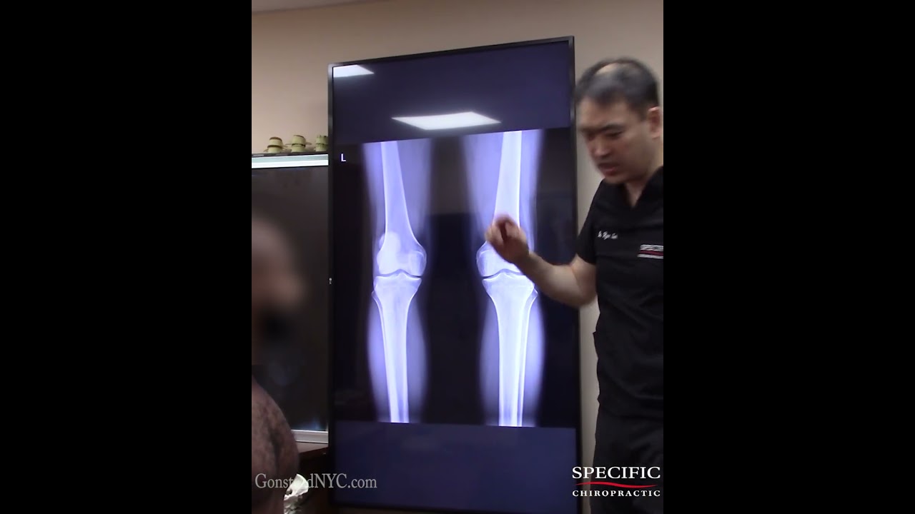 Parkour Knee Injury Fixed by Gonstead Knee Adjustment 💥