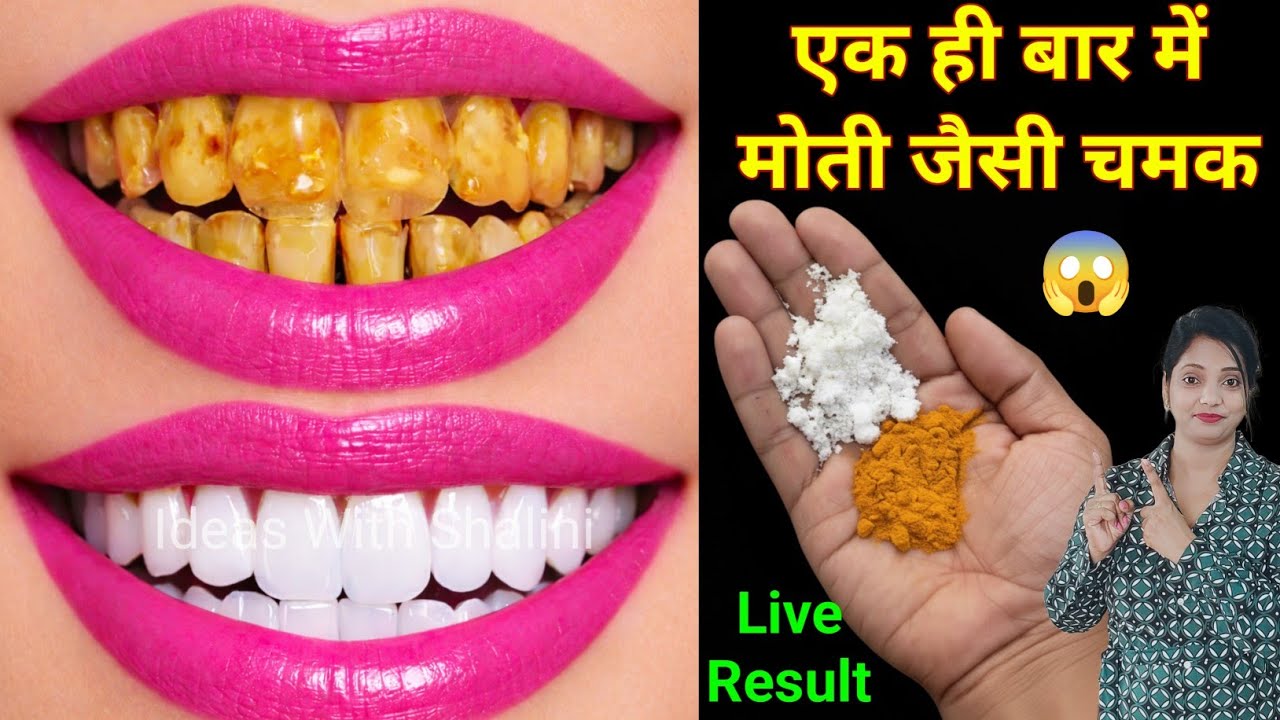 सिर्फ 2 मिनट में पीले गंदे दांतों को मोती की तरह चमका देगा यह घरेलू नुस्खा / Teeth whitening remedy 