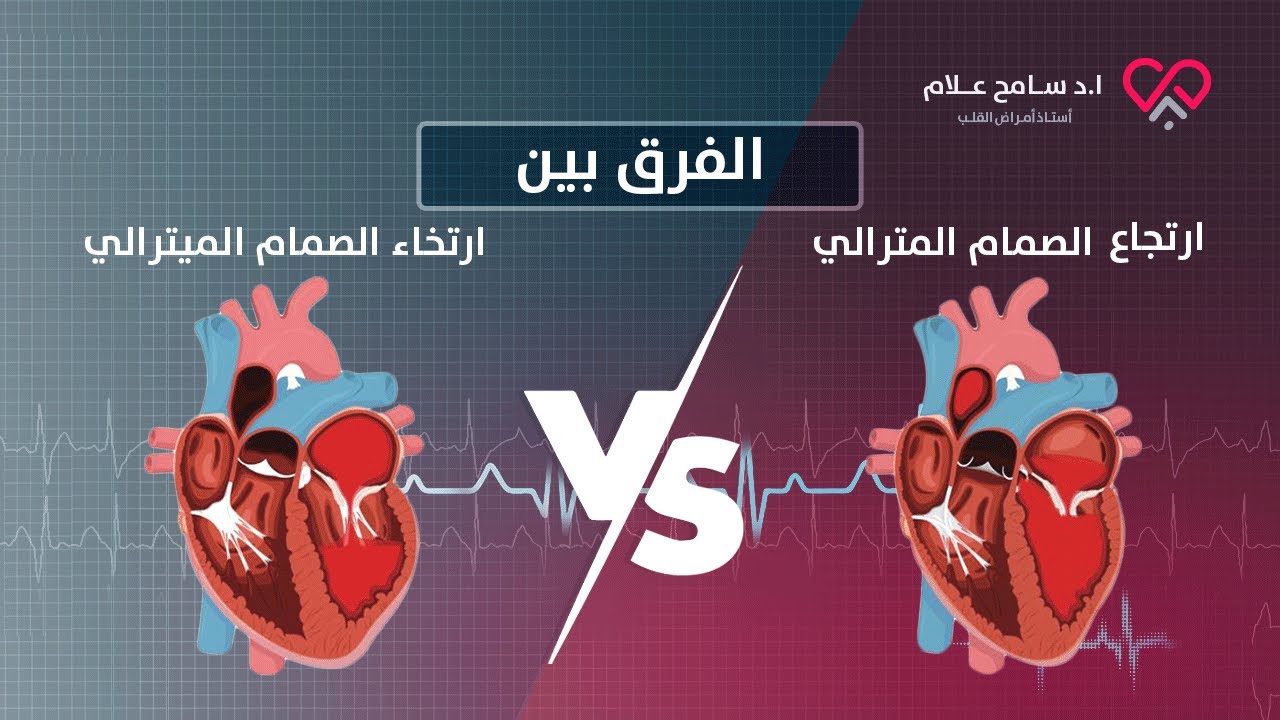 الفرق بين ارتجاع وارتخاء الصمام الميترالي وأيهما أشد خطورة؟ دكتور سامح علام