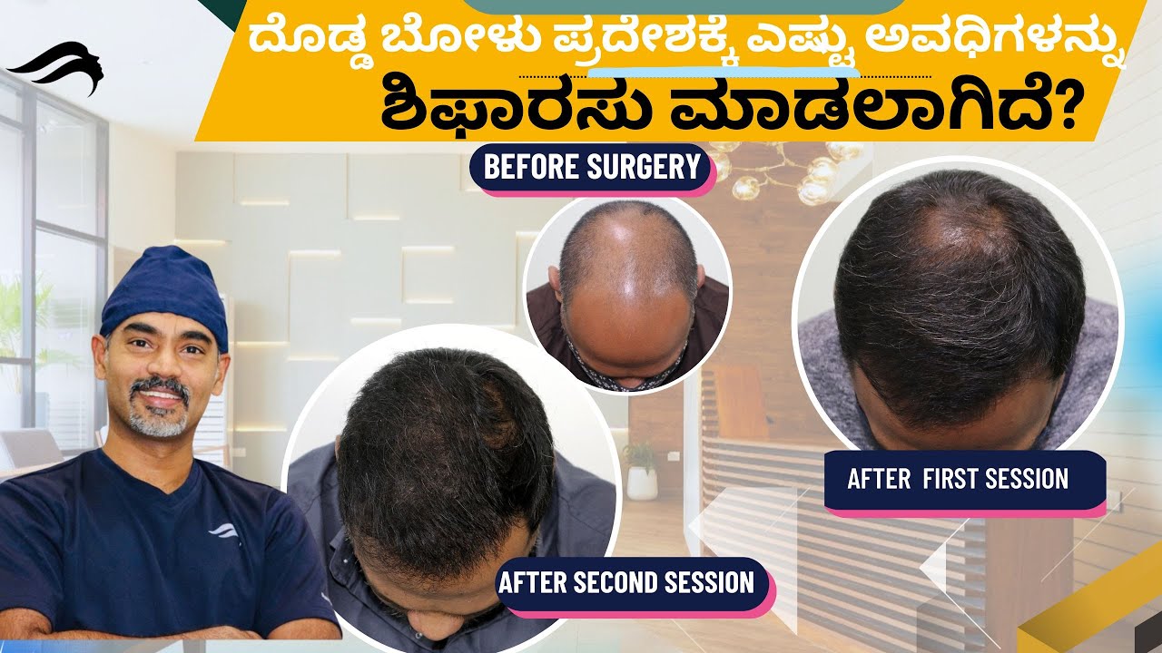 Hair Transplant In Bangalore | Best Doctor Cost & Clinic Of Hair Transplant In Bangalore
