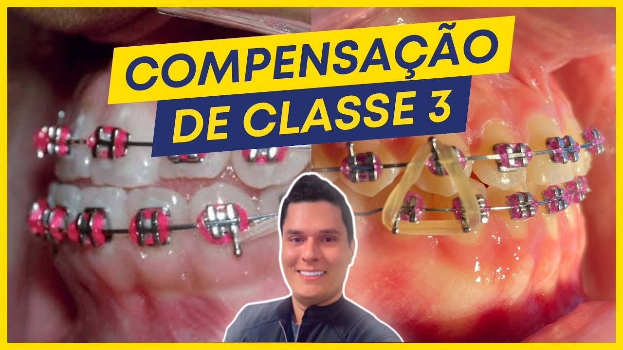 Tratamento Compensatório da Classe 3 | Diagnóstico e Tratamento