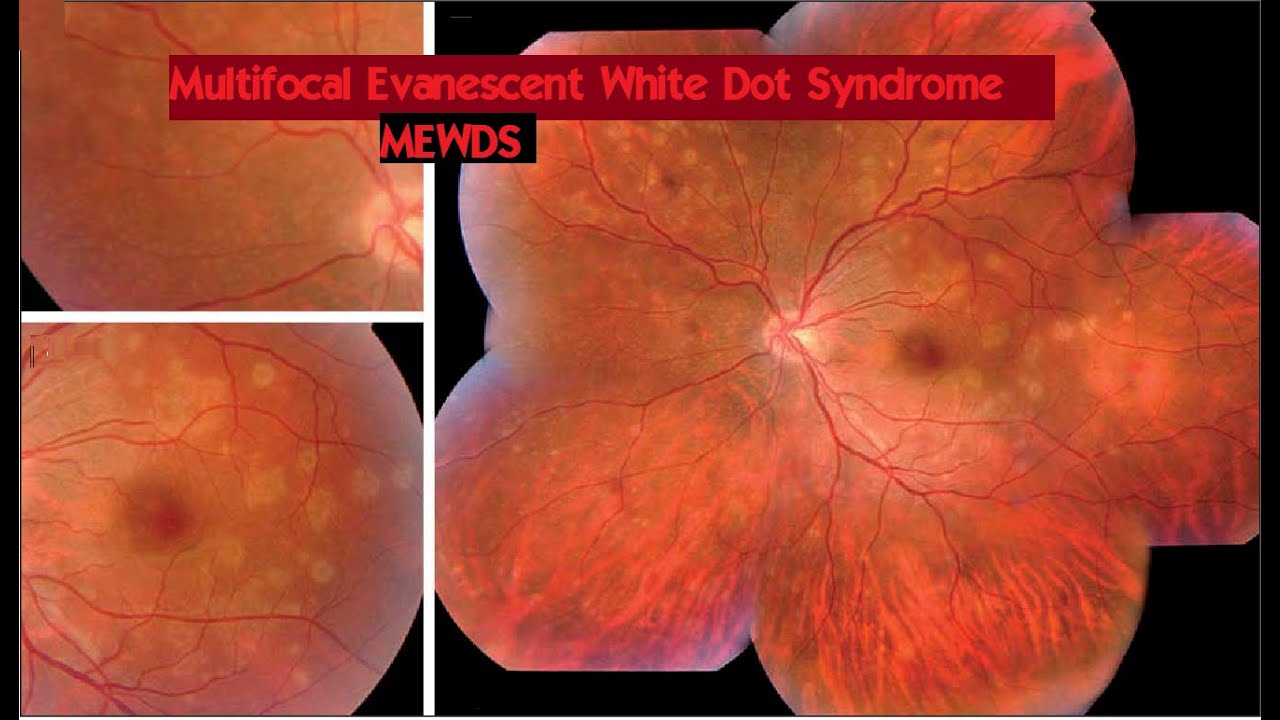 Multiple evanescent white dot syndrome (MEWDS) #KanskiSeries #2022