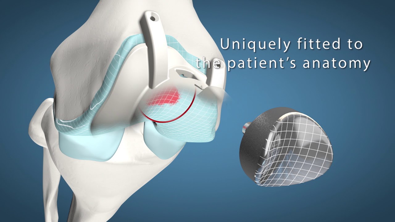 Episealer Knee Trochlea