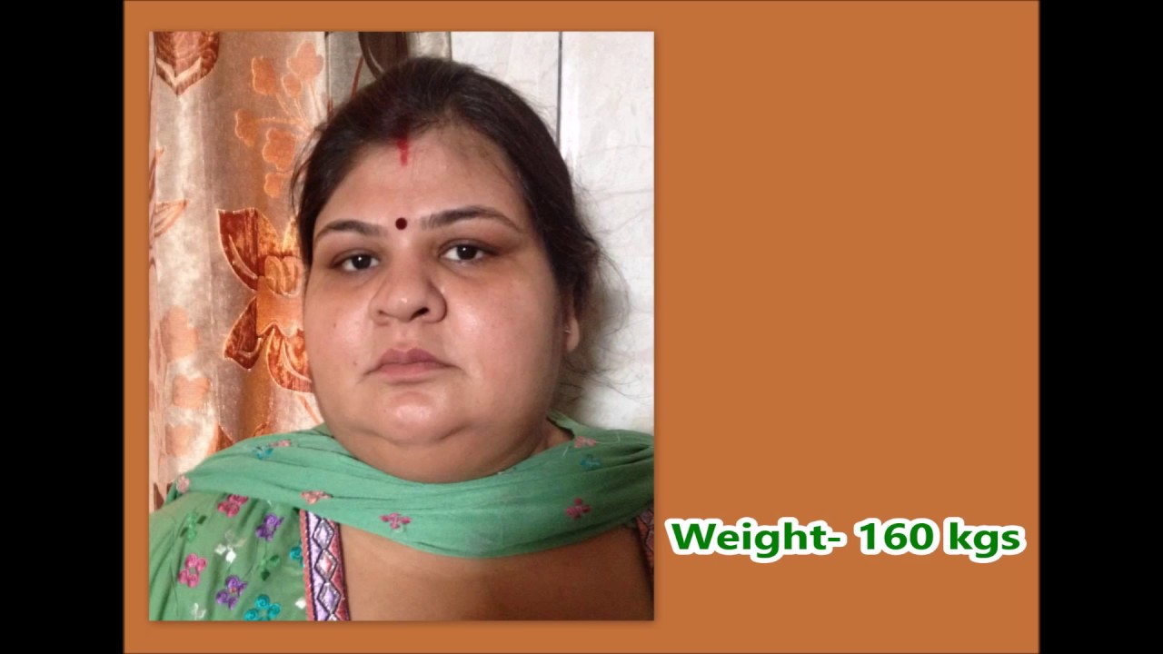 Mini Gastric Bypass India | Punjab | How I lost 87 Kilos |Best obesity surgeon|Dr. Kular