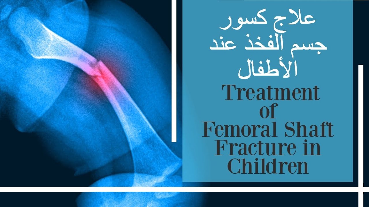 علاج كسور جسم الفخذ عند الأطفال - treatment of femoral shaft fracture in children (subtitled)