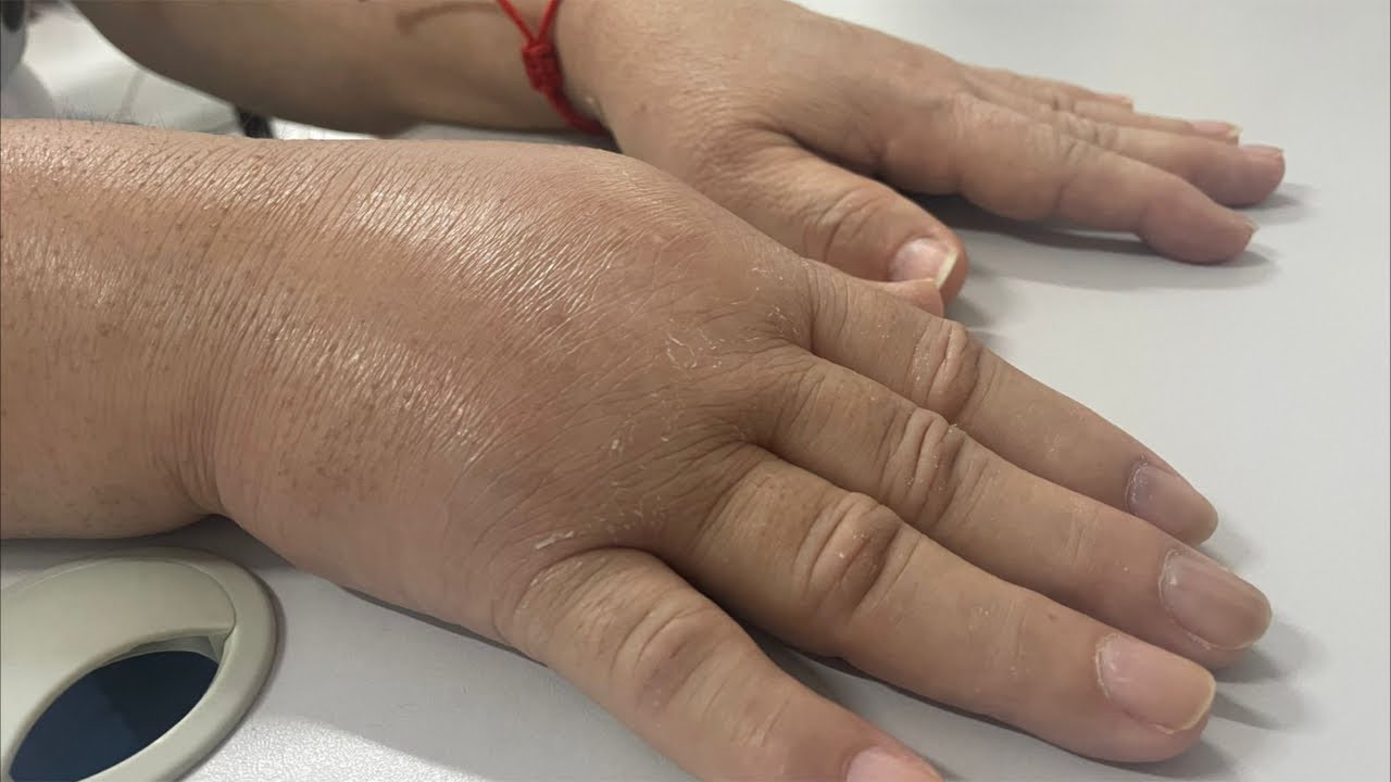 FRATURA DO RÁDIO DISTAL DO PUNHO - FISIOTERAPIA ESPECIALIZADA Dr. Robson Sitta