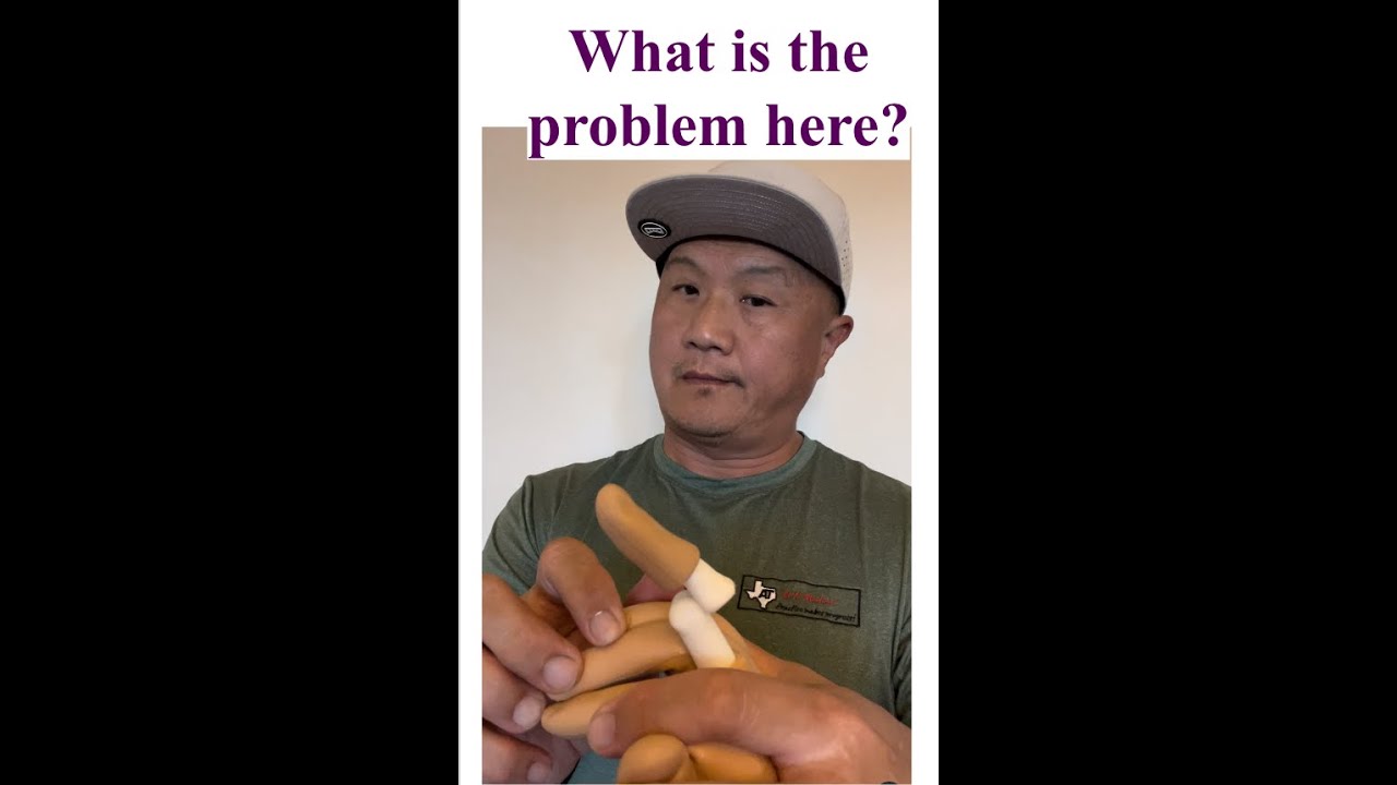 Dorsal Finger Dislocation | Reduction technique | Sports Medicine | Athletic Training |