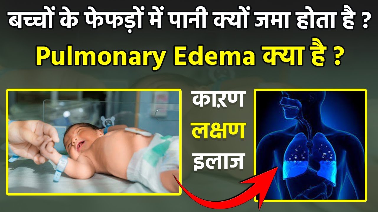 Pulmonary Edema Causes, Symptoms & Treatment | बच्चों के फेफड़ों में पानी क्यों भरता है | Boldsky