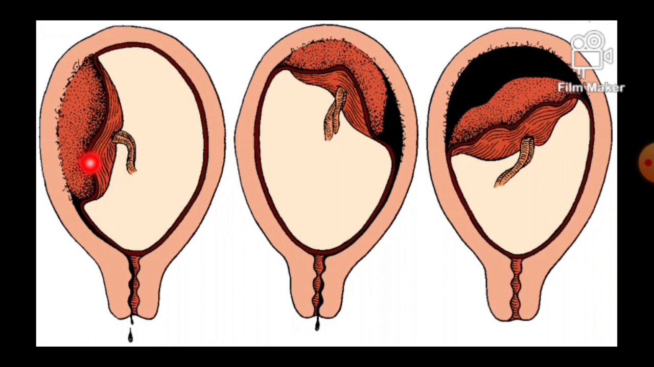 Décollement prématuré du placenta normalement inséré (DPPNI)