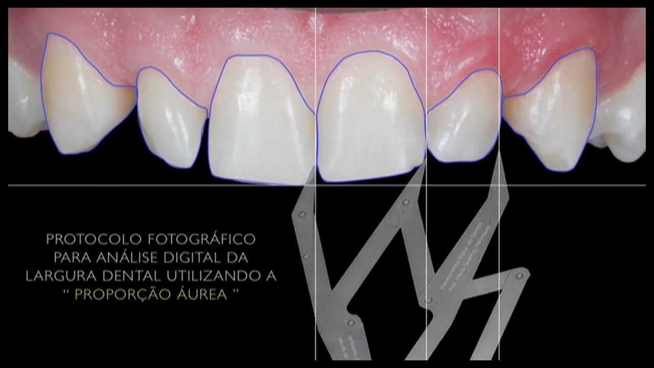 Planejamento Digital do Sorriso (smile design) By Prof. Flavio Queiroz Henriques CD. MS. UFF-RJ