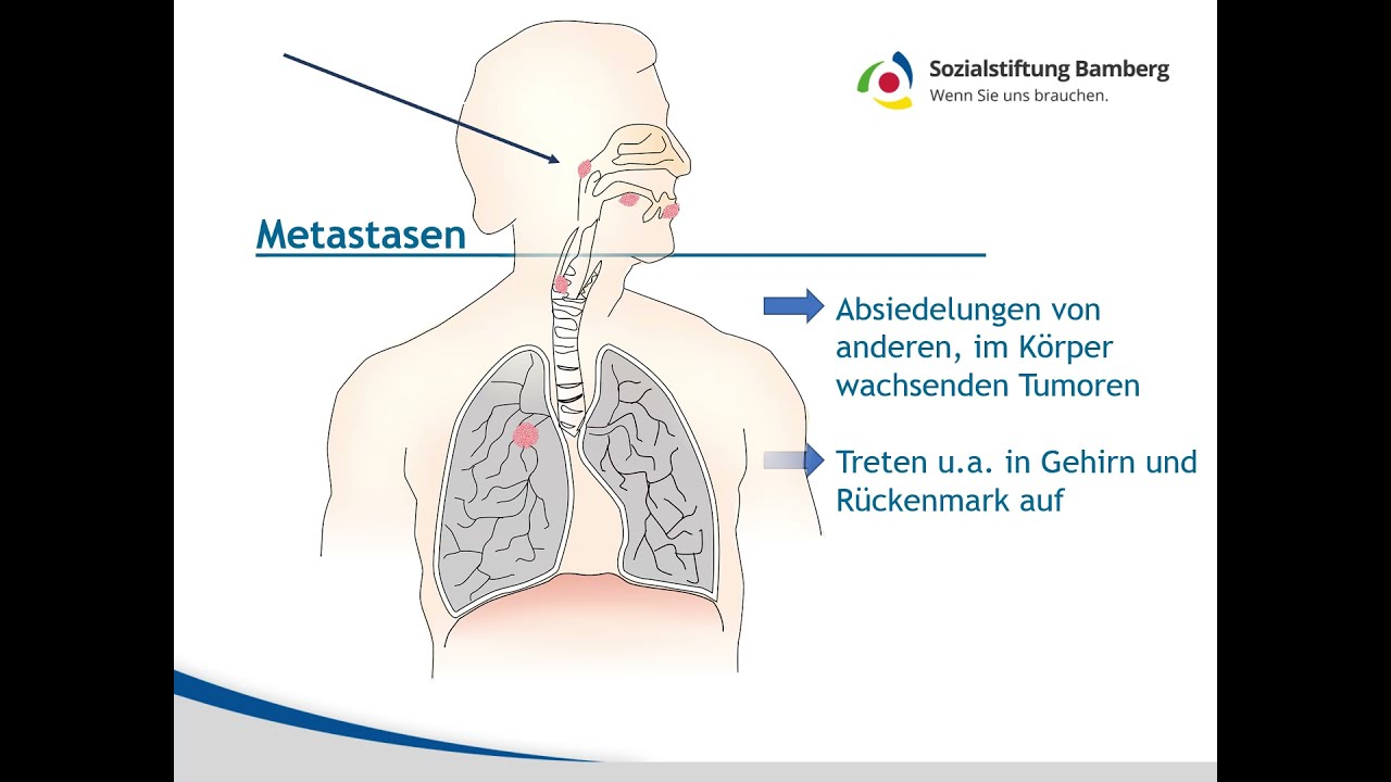 Kurz erkl&auml;rt: Metastasen