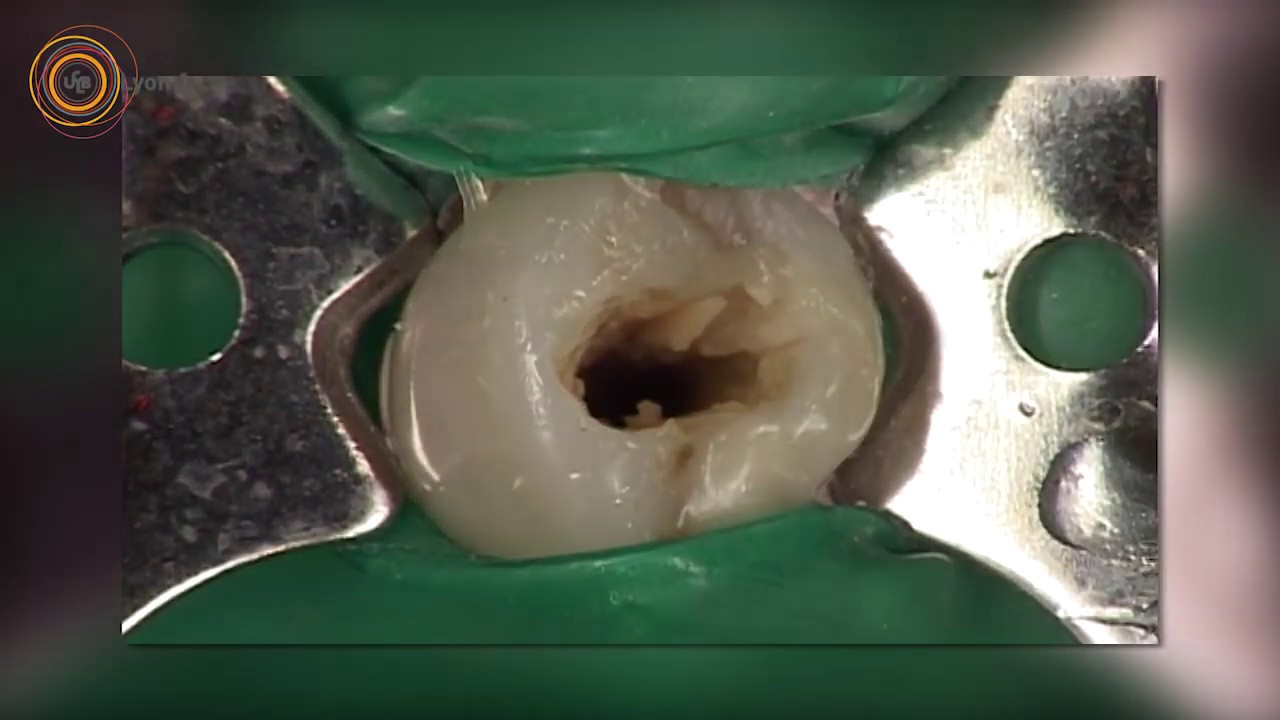 6-La rotation continue; Syst&egrave;me ProTaper Universal -Endodontie
