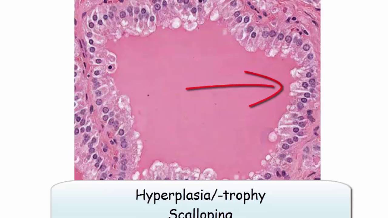12DaysinMarch, Hyperthyroidism for USMLE Step One (Part IV)